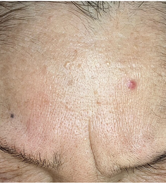 眉間のしわ（70代 5回目）Before