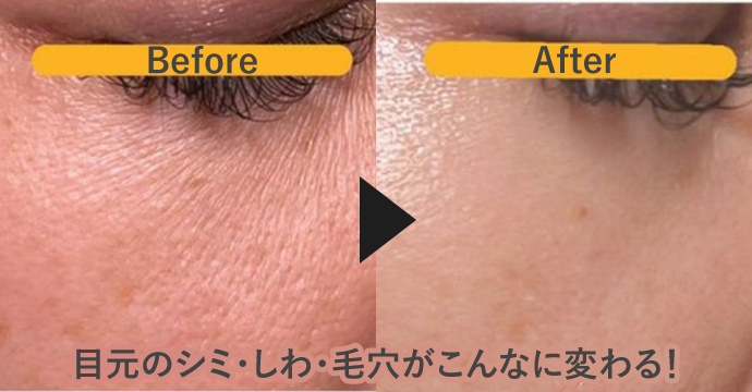 Before ▶︎ After 目元のシミ・しわ・毛穴がこんなに変わる！